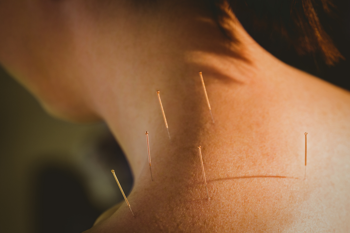 Acupuncture hook basingstoke